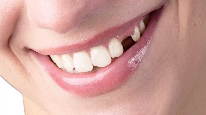 Ý nghĩa đằng sau giấc mơ thấy rụng răng không chảy máu